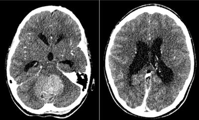 Case report: Turcot syndrome type 2 in a developing country within the Caribbean